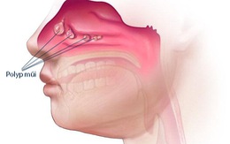 Polyp mũi - Nguyên nhân và cách điều trị