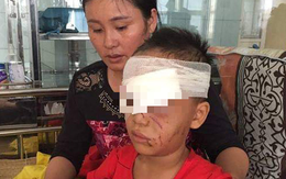 Thanh Hóa: Bé trai 6 tuổi bị chó nhà cắn suýt hư mắt