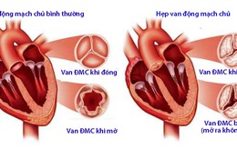 Hen tim: Những điều cần biết