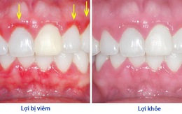 Nguyên nhân gây bệnh viêm lợi và cách điều trị