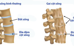 Nguyên tắc dinh dưỡng của bệnh gai cột sống