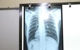 Nam bệnh nhân phủ tạng đảo ngược ở Hà Nội: tim bên phải, gan bên trái