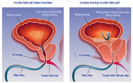 Ảnh hưởng của điều trị phì đại tiền liệt tuyến lành tính đến khả năng tình dục