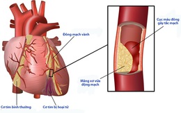 Biến chứng tim mạch của bệnh đái tháo đường