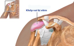 Viêm quanh khớp vai