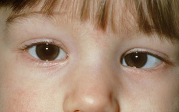 Lác mắt, nguyên nhân và cách điều trị