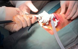 Lần đầu phẫu thuật nội soi cắt tuyến giáp không để lại sẹo