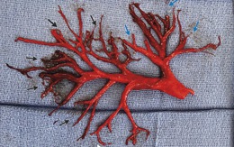 Vì sao bệnh nhân Mỹ ho ra máu đông hình cây phế quản?