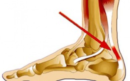Đau gót chân (heel pain)