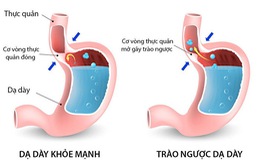 Cẩn thận với bệnh trào ngược dạ dày, thực quản