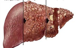 Viêm gan mạn tính tự miễn