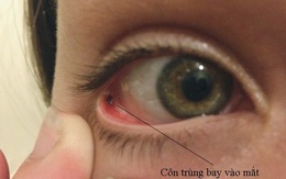 Đề phòng chấn thương mắt do côn trùng