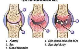 10 cách ngăn ngừa thoái hóa khớp