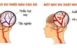 Chứng đột quỵ ở người cao tuổi