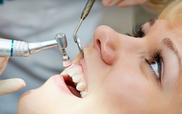 Khi nào nên lấy cao răng?