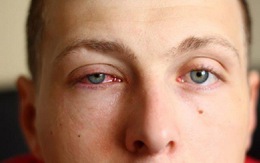 Nhận biết và phòng bệnh đau mắt đỏ