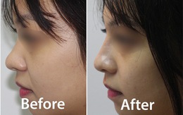 Những điều chị em nên biết khi làm đẹp bằng Filler