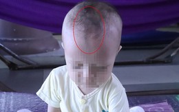 Đường gờ dọc trán trẻ có nguy hiểm?