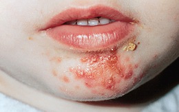 Nhận biết và xử trí bệnh chốc lở ngoài da ở trẻ em