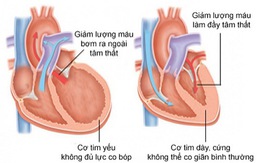 Những lưu ý trong điều trị suy tim