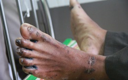 Một học sinh mắc hội chứng viêm da dày sừng tay, chân tử vong