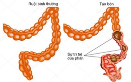 Chọn thuốc nhuận tràng cho người cao tuổi