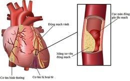 Yếu tố gây nên bệnh lý nhồi máu cơ tim hay bệnh vành tim