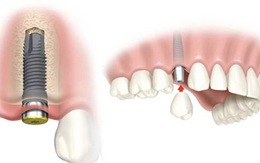 Ưu điểm răng Implant ETK Active của Nha Khoa Đông Nam