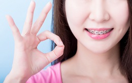 Phương pháp niềng răng phù hợp cho tuổi thanh, thiếu niên