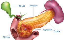 Bệnh viêm tụy cấp