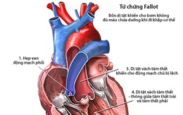 Các bệnh tim bẩm sinh thường gặp