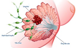 Các yếu tố nguy cơ phát triển ung thư vú