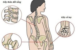 Đừng đợi đến khi bác sĩ kết luận bị loãng xương mới bổ sung canxi