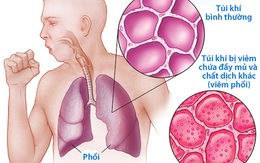 Hiểu đúng về viêm phổi
