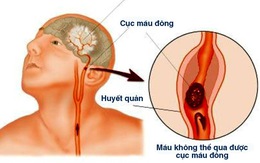 Bệnh nhồi máu não