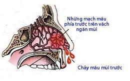 Chảy máu mũi