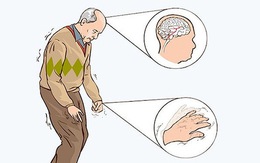 Bệnh Parkinson, người cao tuổi nên biết