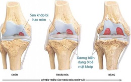 Giúp giảm đau, kháng viêm, ngừa thoái hóa sụn khớp với Crux