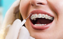 Vì sao cần nắn chỉnh răng?