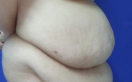 Cắt hơn 6 kg da và mỡ bụng cho nữ bệnh nhân có mỡ xếp thành lớp