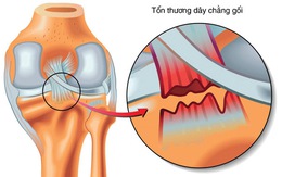 Phát hiện tế bào gốc dây chằng, sẽ hồi phục dây chằng không phải mổ?