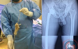 Ghép xương đùi nhân tạo in 3D cho bệnh nhân có khối u phì đại