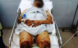 Việt kiều về quê ăn tết bị tạt axit, cắt gân chân