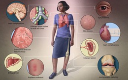 Bệnh sarcoidosis