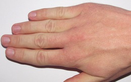 10 lý do khiến bạn luôn bị lạnh đôi bàn tay