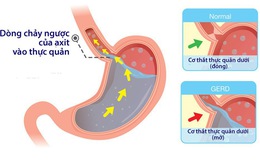 Sự khác biệt giữa chứng ợ nóng và bệnh tim mạch