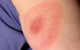 Bệnh Lyme