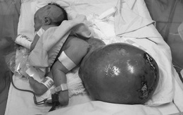 Cứu sống bé gái sơ sinh có bướu quái nặng gấp 1,5 lần cơ thể