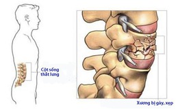 Gãy xẹp - Lún đốt sống