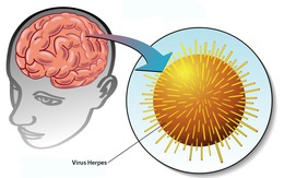 Bệnh viêm não do virus Herpes simplex